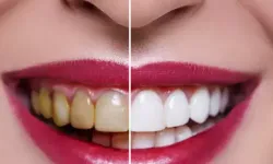 Dişlerinizi bu yöntemle anında beyazlatabilirsiniz!