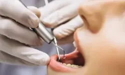 Diş dolgusundaki büyük tehlike: Bazı ülkelerde yasaklandı!