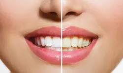 Dişlerdeki sararmalara bu yöntemle dur diyebilirsiniz!