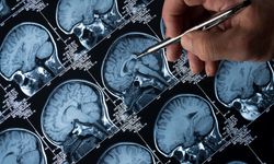 Alzheimer Vakalarında Endişe Verici Artış: Bilim İnsanları Uyarıyor