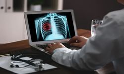 Her Yıl 2 Buçuk Milyon İnsan Akciğer Kanseri Nedeniyle Hayatını Kaybediyor