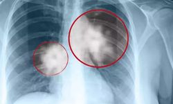 Göğüs cerrahisi uzmanı uyardı: Geç kalmayın!