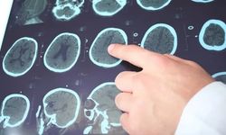 Nöroloji uzmanı açıkladı: Ciddi kafa travmaları bu hastalığa sebep olabilir!