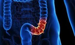 Uzman doktor uyardı: Divertikül tehlikesine karşı dikkat!