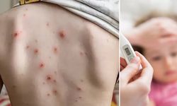 Okullarda suçiçeği alarmı: Vakalar Arttı!