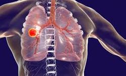 Verem hala tehdit: Uzmanlardan erken tanı uyarısı!