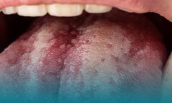 Ağız Kuruluğu Masum Bir Şikâyet Değil