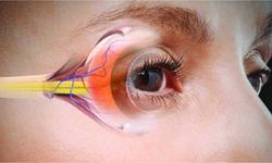 Uzman doktor uyardı! Glakom sinsi ilerleyebilir: Görme kaybı son ana kadar fark edilmeyebilir!