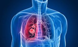 Uzman doktordan uyarı! Zatürreye dikkat: Yüksek ölüm oranına sahip bir hastalık!