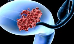 Uzman hekim uyardı! Yarın çok geç olabilir: Erken teşhis hayat kurtarıyor!