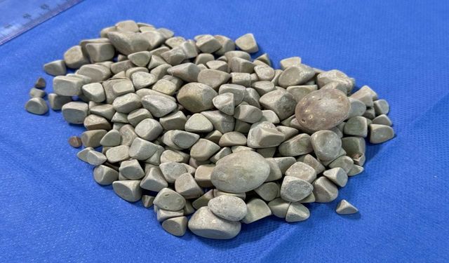 Doktorlar şokta: Vücudundan tam 287 tane taş çıkarıldı!