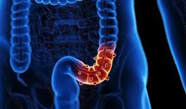 Uzman doktor uyardı: Divertikül tehlikesine karşı dikkat!