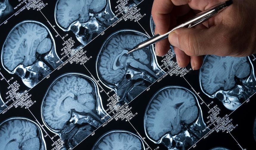 Alzheimer Vakalarında Endişe Verici Artış: Bilim İnsanları Uyarıyor