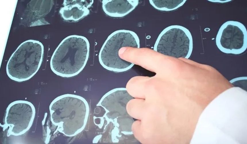 Nöroloji uzmanı açıkladı: Ciddi kafa travmaları bu hastalığa sebep olabilir!
