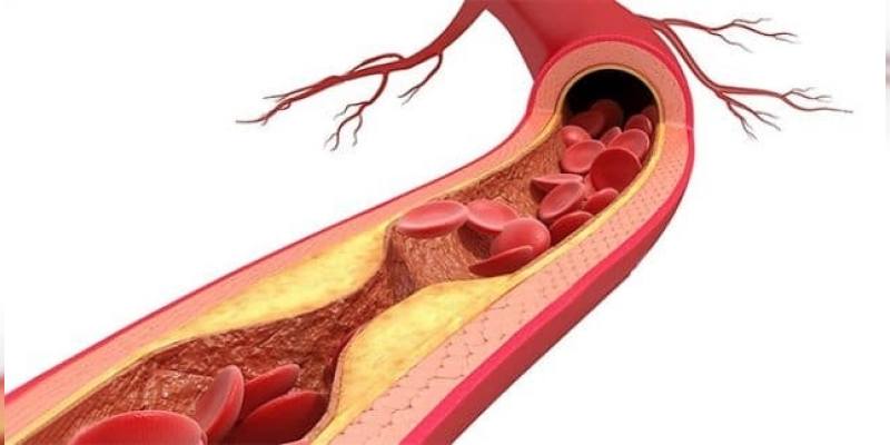 Ateroskleroz Damar Sertligi Nedir 800X400