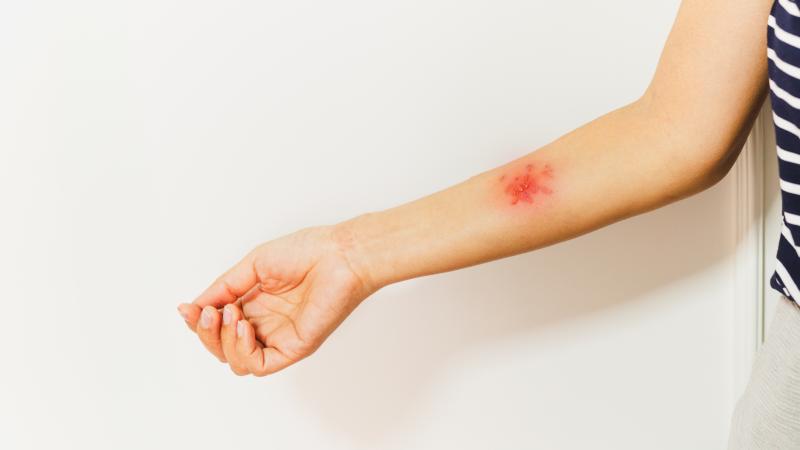 Cilt Hastaligi Kastamonu Saglik Yasam