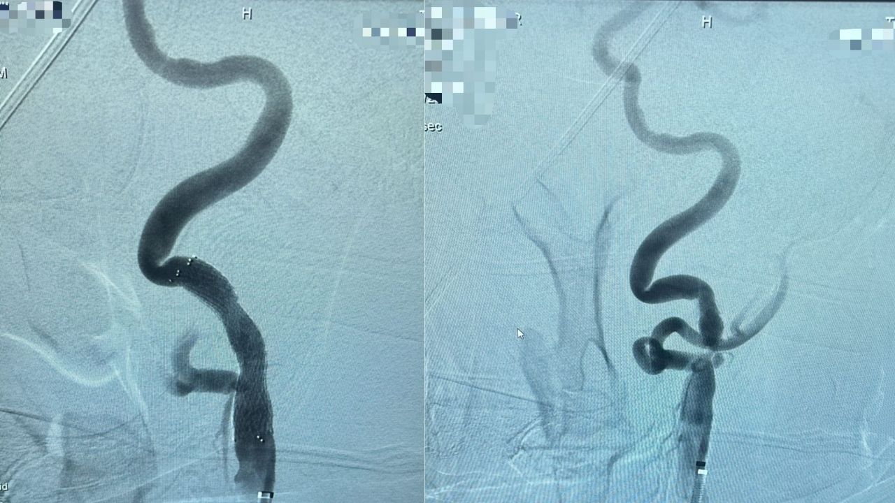 Kastamonu'da Şah Damarı Darlıklarının Stent Tedavisi Başladı (3)