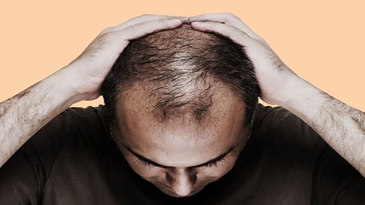 Saç Dökülmesi Kel 1