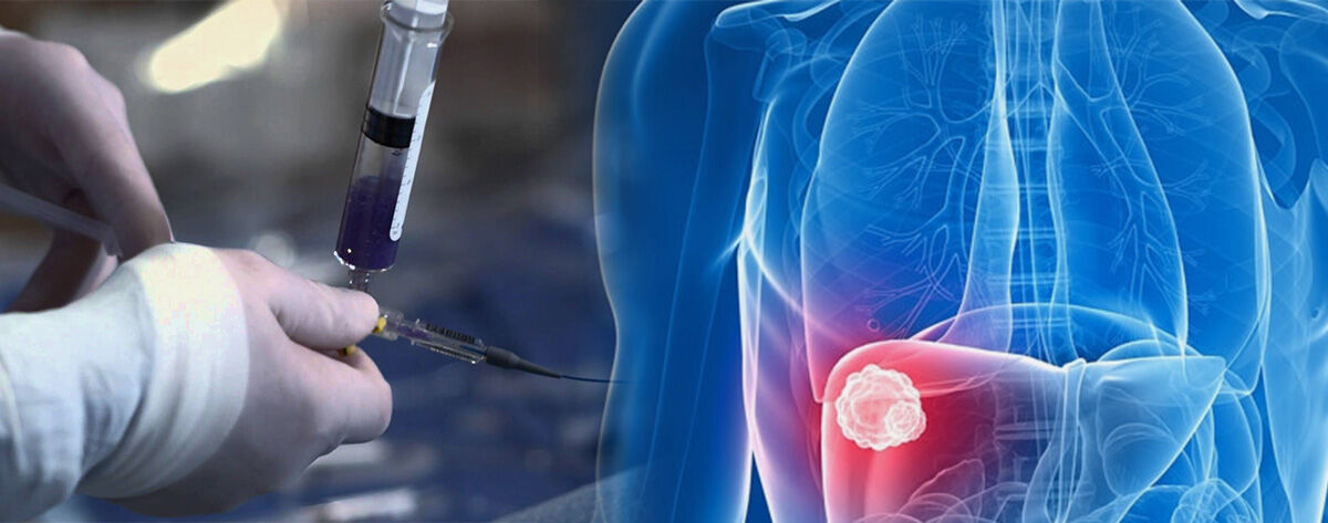 Uzman Doktor Açıkladı Kanser Tedavisinde Bu Yaklaşımlar Öne Çıkıyor 88