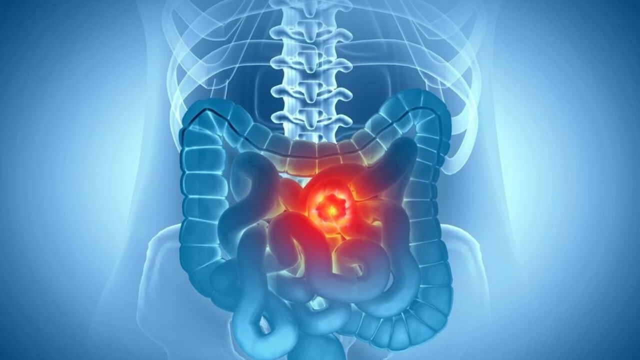 Çocukken Yapılan Bu Alışkanlıklar Genç Yaşta Kanser Riskini Artırıyor (2)