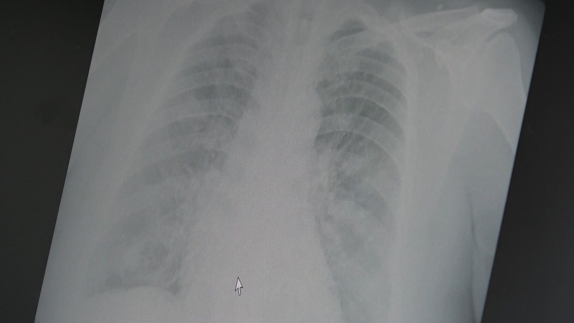 Grip Vakaları Artıyor Aşılar Neden Yetersiz Kalıyor1