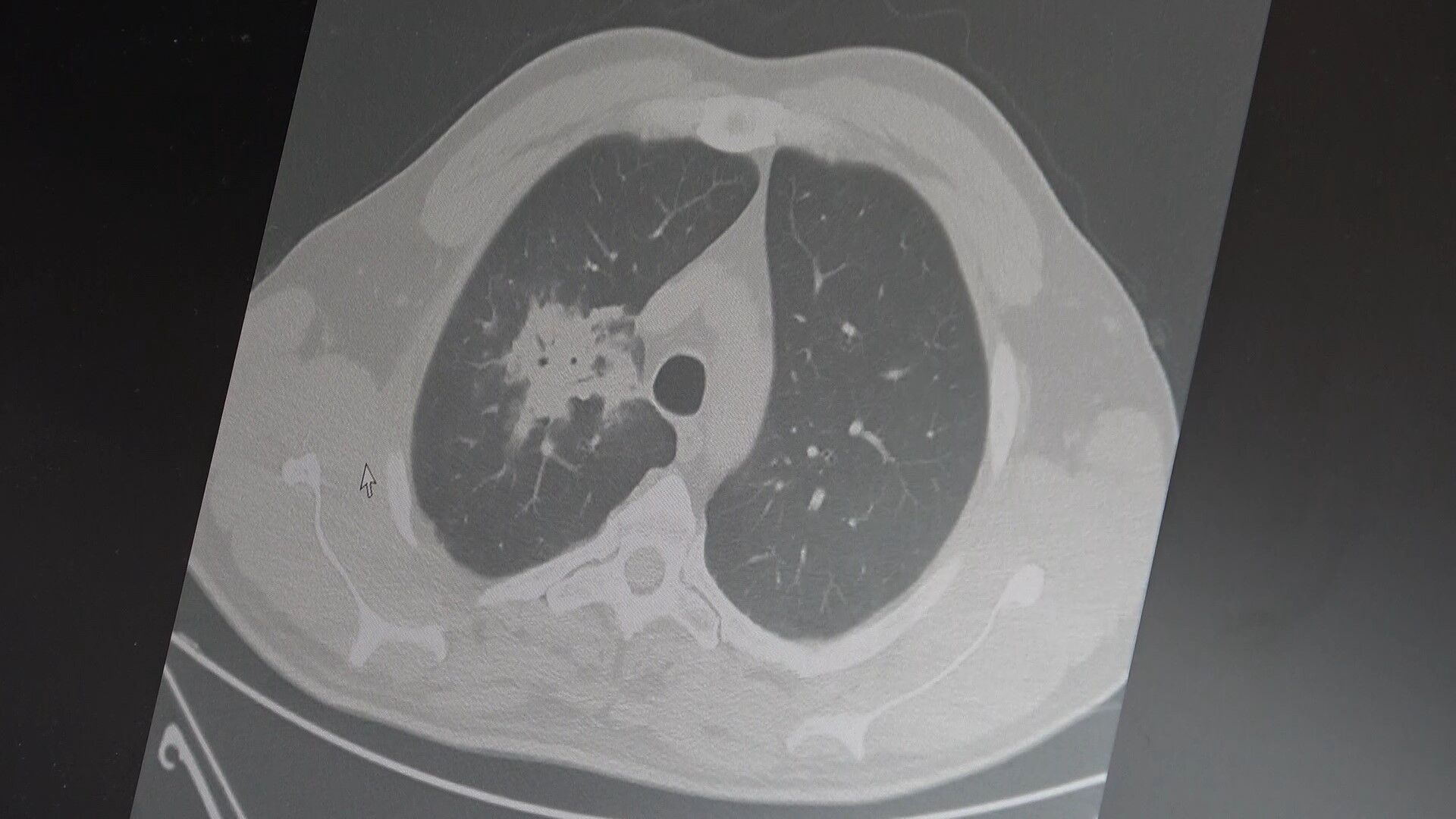 Elektronik Sigara Kanser Riskini Artırıyor 22-3